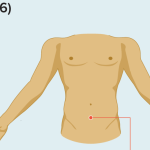 طب سوزنی برای دیسک کمر
